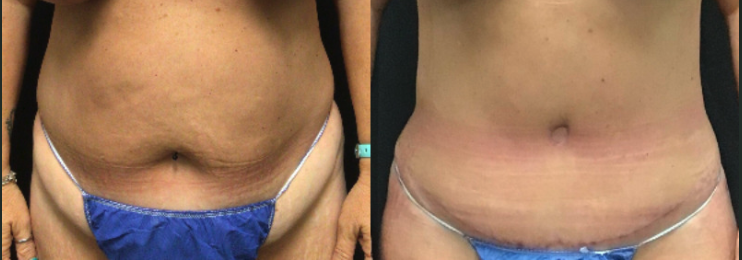 Tummy tuck before and after patient 3